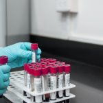 Acido urico alto, una minaccia per cuore e circolazione