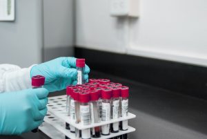 Acido urico alto, una minaccia per cuore e circolazione