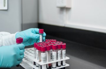 Acido urico alto, una minaccia per cuore e circolazione