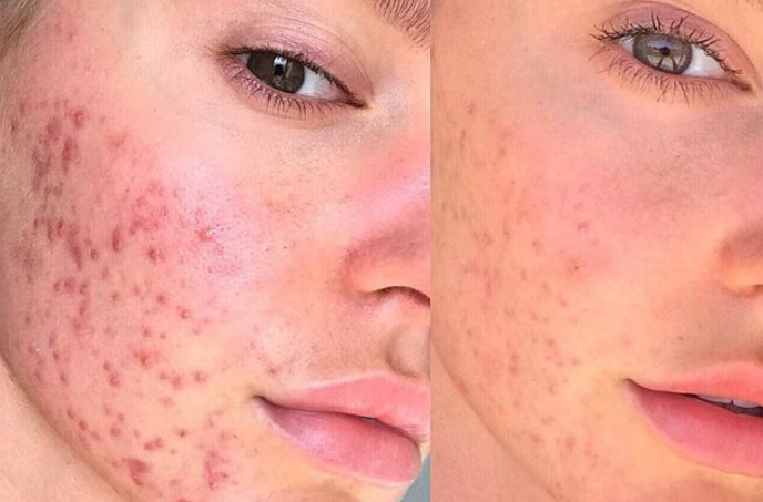 Acne, batteri al posto degli antibiotici