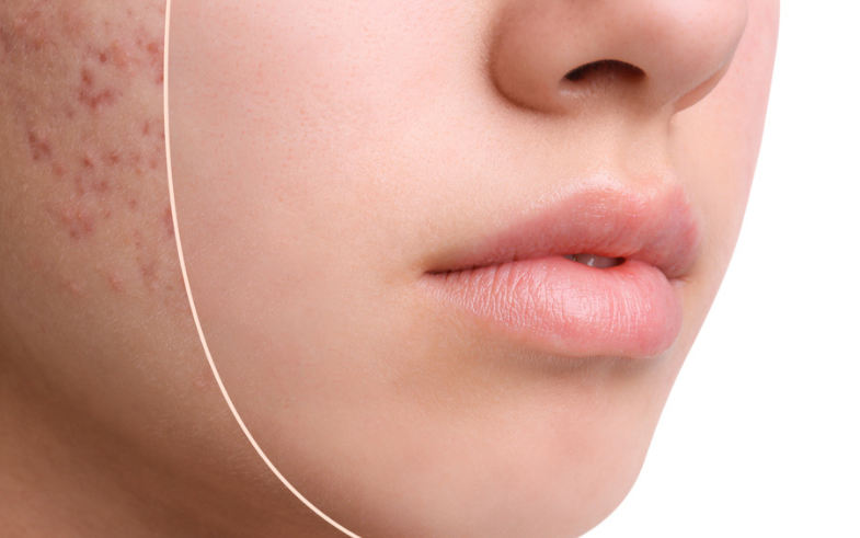 Acne, studio evidenzia collegamento con importante nutriente chiave
