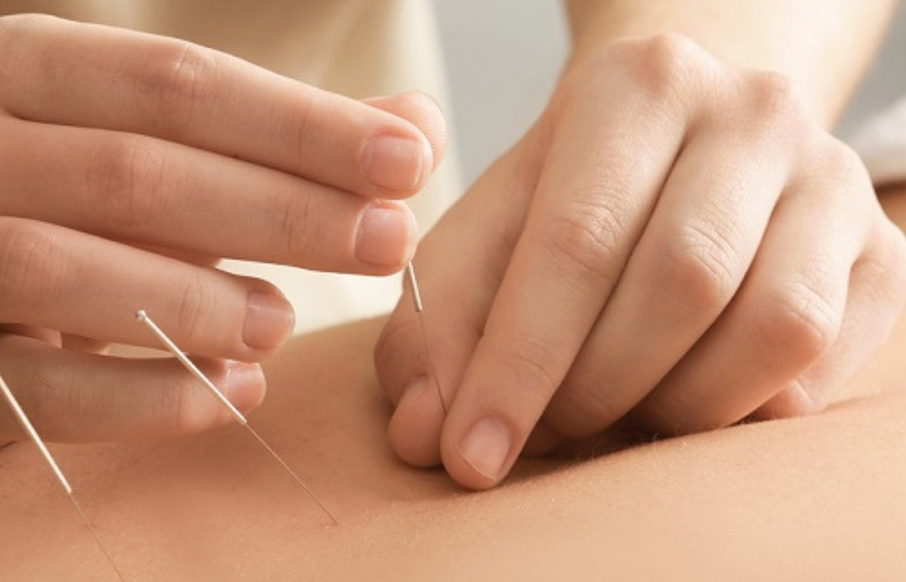 Utilità dell'agopuntura per evitare il diabete di tipo 2