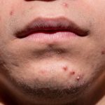 L’acne non è solo un problema da adolescenti. Sempre più spesso compare anche in età adulta e, quando diventa persistente, limitarsi a trattamenti locali raramente basta. Rimedi mirati sulla pelle (come leggere applicazioni di olio essenziale di lavanda miscelato con tea tree) possono aiutare a ridurre l’infiammazione, ma per ottenere risultati duraturi è necessario intervenire sulle cause profonde. Negli ultimi anni la ricerca ha evidenziato diversi fattori metabolici e nutrizionali coinvolti. Tra questi spicca il legame tra acne e consumo di latte e latticini. Parallelamente è stata osservata una correlazione con l’aumento della resistenza insulinica: per questo molti esperti suggeriscono un’alimentazione a basso indice glicemico. Ridurre gli zuccheri rapidi e i picchi glicemici può contribuire ad abbassare i livelli di androgeni liberi e a diminuire la produzione di IGF-1 (Insulin Like Growth Factor 1), una molecola con azione proinfiammatoria coinvolta nei processi acneici. Un ruolo sempre più discusso riguarda anche gli omega-3. Alcuni studi indicano che questi acidi grassi essenziali possono contribuire a modulare l’infiammazione cutanea e a migliorare l’equilibrio delle ghiandole sebacee, rendendoli un nutriente chiave nella gestione dell’acne. Non meno importante è la salute dell’intestino. Alterazioni del microbiota intestinale e stati infiammatori cronici possono riflettersi sulla pelle: per questo il riequilibrio intestinale, attraverso dieta mirata e sostegno del microbiota, è considerato un tassello fondamentale. Sul fronte dell’integrazione, sostanze come l’inositolo, utile per il metabolismo ormonale, e oligoelementi come manganese, rame, zinco e cromo possono facilitare il percorso. In sintesi, la pelle spesso racconta ciò che accade dentro l’organismo: affrontare l’acne in modo efficace significa guardare oltre lo specchio e intervenire su alimentazione, infiammazione e equilibrio metabolico.