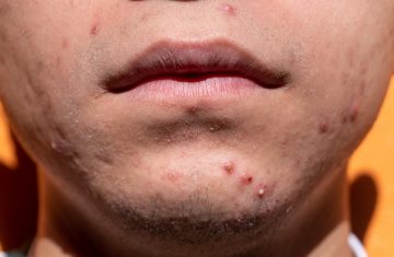 L’acne non è solo un problema da adolescenti. Sempre più spesso compare anche in età adulta e, quando diventa persistente, limitarsi a trattamenti locali raramente basta. Rimedi mirati sulla pelle (come leggere applicazioni di olio essenziale di lavanda miscelato con tea tree) possono aiutare a ridurre l’infiammazione, ma per ottenere risultati duraturi è necessario intervenire sulle cause profonde. Negli ultimi anni la ricerca ha evidenziato diversi fattori metabolici e nutrizionali coinvolti. Tra questi spicca il legame tra acne e consumo di latte e latticini. Parallelamente è stata osservata una correlazione con l’aumento della resistenza insulinica: per questo molti esperti suggeriscono un’alimentazione a basso indice glicemico. Ridurre gli zuccheri rapidi e i picchi glicemici può contribuire ad abbassare i livelli di androgeni liberi e a diminuire la produzione di IGF-1 (Insulin Like Growth Factor 1), una molecola con azione proinfiammatoria coinvolta nei processi acneici. Un ruolo sempre più discusso riguarda anche gli omega-3. Alcuni studi indicano che questi acidi grassi essenziali possono contribuire a modulare l’infiammazione cutanea e a migliorare l’equilibrio delle ghiandole sebacee, rendendoli un nutriente chiave nella gestione dell’acne. Non meno importante è la salute dell’intestino. Alterazioni del microbiota intestinale e stati infiammatori cronici possono riflettersi sulla pelle: per questo il riequilibrio intestinale, attraverso dieta mirata e sostegno del microbiota, è considerato un tassello fondamentale. Sul fronte dell’integrazione, sostanze come l’inositolo, utile per il metabolismo ormonale, e oligoelementi come manganese, rame, zinco e cromo possono facilitare il percorso. In sintesi, la pelle spesso racconta ciò che accade dentro l’organismo: affrontare l’acne in modo efficace significa guardare oltre lo specchio e intervenire su alimentazione, infiammazione e equilibrio metabolico.